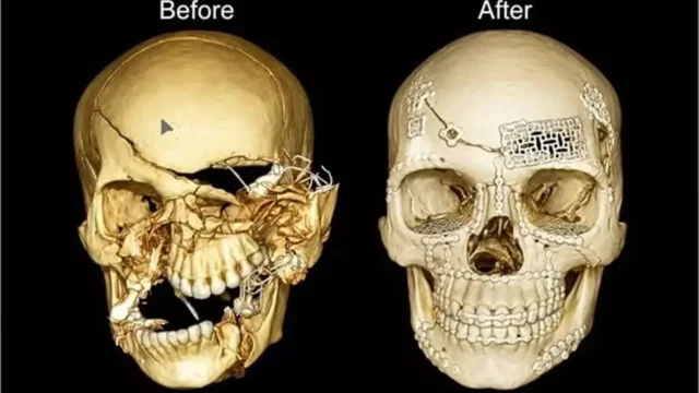 मौ+त से जंग जीतकर लौटा 27 साल का युवक, दिल्ली के डॉक्टरों ने उसकी अपनी हड्डी से दोबारा बनाई खोपड़ी