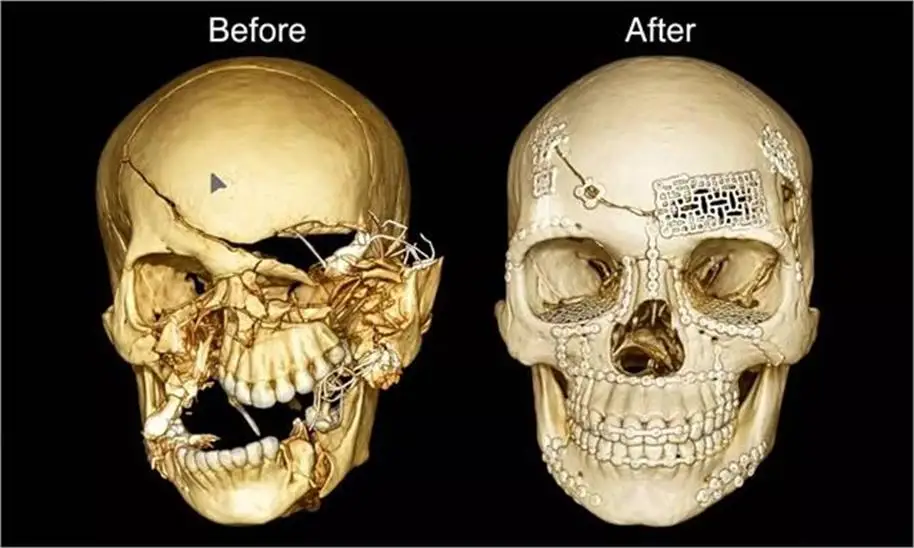 मौ+त से जंग जीतकर लौटा 27 साल का युवक, दिल्ली के डॉक्टरों ने उसकी अपनी हड्डी से दोबारा बनाई खोपड़ी