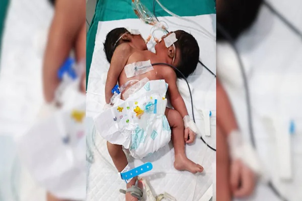 दो सिर, दो रीढ़ और एक शरीर… जन्म के कुछ दिन बाद जुड़वां बच्चों की मौ+त